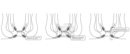 Diseases of the anus, hemorrhoids "Anorectal hemorrhoids" Illustration, cross-sectional view - Translation: Perianal abscess progresses, pus drains and tunnels form
