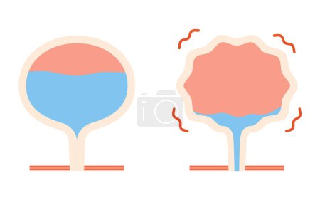 Ilustración de Ilustración médica de vejiga hiperactiva, vejiga normal vs, ilustración vectorial - Imagen libre de derechos