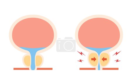 Ilustración médica de hiperplasia prostática benigna, próstata normal vs. agrandada, ilustración vectorial