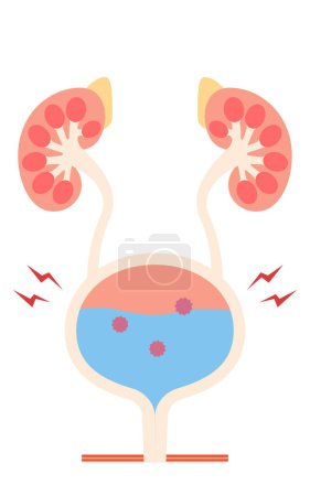 Medizinische Illustration von Blasenentzündung, Harnröhre, Blase, Harnleiter, Niere, Vektorillustration