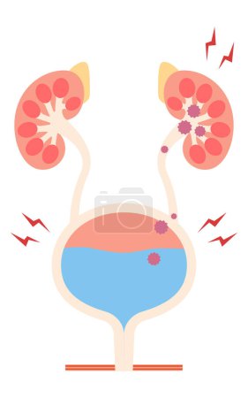 Illustration médicale de la pyélonéphrite, le reflux des bactéries de la vessie vers les reins, Illustration vectorielle