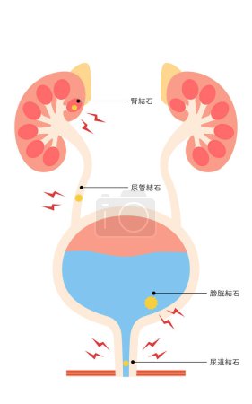 Medical illustration of urinary tract stones - Translation: Kidney Stones, Urinary Tract Stones, Bladder Stones, Urethral Stones