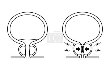 Illustration médicale de l'hyperplasie bénigne de la prostate, normale vs hypertrophie de la prostate, Illustration vectorielle