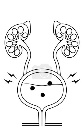 Ilustración médica de cistitis, uretra, vejiga, uréter, riñón, Vector Ilustración