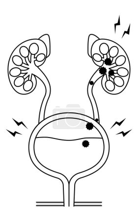 Medizinische Illustration der Pyelonephritis, des Rückflusses von Bakterien aus der Blase in die Nieren, Vektor Illustration