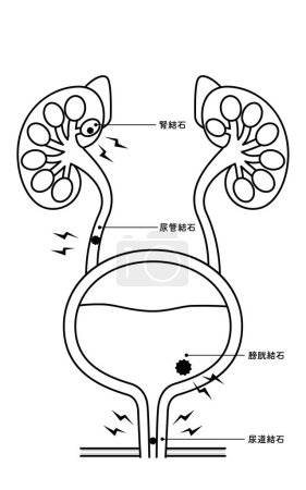 Ilustración médica de cálculos del tracto urinario - Traducción: cálculos renales, cálculos del tracto urinario, cálculos de la vejiga, cálculos uretrales