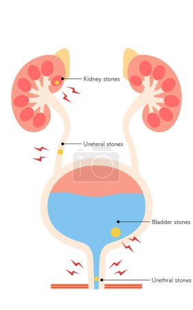 Ilustración médica de cálculos del tracto urinario, ilustración vectorial