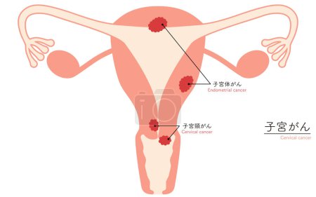 Ilustración diagramática del cáncer de cuello uterino, anatomía del útero y ovarios, ilustración vectorial