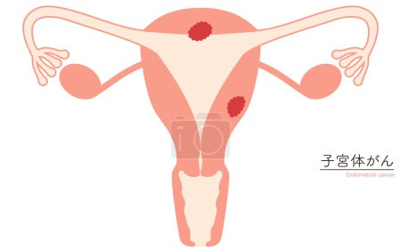 Illustrative Illustrationen zu Endometriumkrebs, Anatomie der Gebärmutter und der Eierstöcke, Vektorillustration