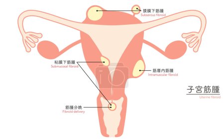 Illustration for Diagrammatic illustration of uterine fibroids, anatomy of the uterus and ovaries, Vector Illustration - Royalty Free Image