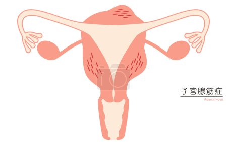Téléchargez les illustrations : Illustration schématique de l'adénomyose, anatomie de l'utérus et des ovaires, Illustration vectorielle - en licence libre de droit