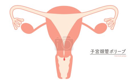 Diagrammatische Darstellung der zervikalen Polypen, Anatomie der Gebärmutter und der Eierstöcke, Vektorillustration
