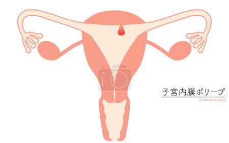Illustration schématique des polypes endométriaux, anatomie de l'utérus et des ovaires, Illustration vectorielle
