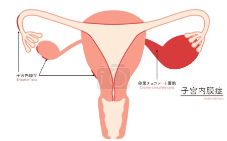 Ilustración diagramática de endometriosis, anatomía del útero y ovarios, ilustración vectorial
