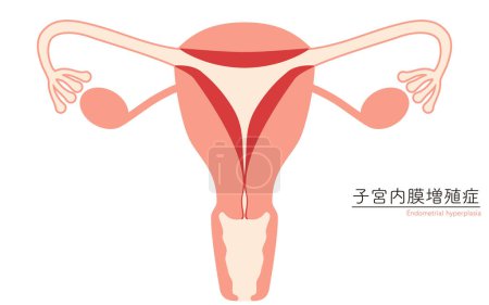 Diagrammatische Darstellung der endometrischen Hyperplasie, Anatomie der Gebärmutter und der Eierstöcke, Vektorillustration