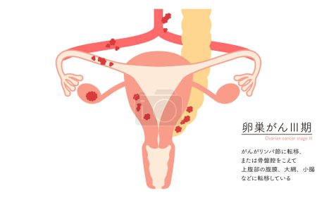 Diagrammatic illustration of stage III ovarian cancer, anatomy of the uterus and ovaries, anatomy of the uterus and ovaries - Translation: Cancer has spread to the lymph nodes or across the pelvic cavity to the peritoneum, large mesentery, or small i