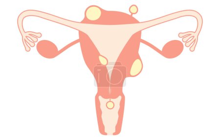 Ilustración diagramática de fibromas uterinos, anatomía del útero y ovarios, ilustración vectorial