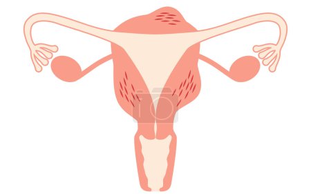 Diagrammatische Darstellung der Adenomyose, Anatomie der Gebärmutter und der Eierstöcke, Vektorillustration