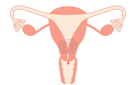 Ilustración de Ilustración diagramática de pólipos cervicales, anatomía del útero y ovarios, ilustración vectorial - Imagen libre de derechos