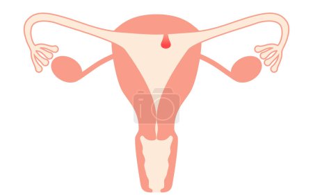 Ilustración diagramática de pólipos endometriales, anatomía del útero y ovarios, ilustración vectorial