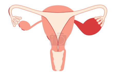 Diagrammatic illustration of endometriosis, anatomy of the uterus and ovaries, Vector Illustration