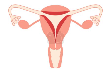 Ilustración diagramática de hiperplasia endometrial, anatomía del útero y ovarios, ilustración vectorial