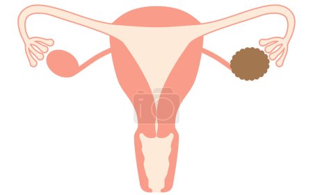 Ilustración diagramática de quistes ováricos, anatomía del útero y ovarios, ilustración vectorial