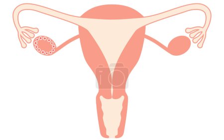 Diagrammatische Darstellung des polyzystischen Ovar-Syndroms (Reifungsstörung), der Anatomie der Gebärmutter und der Eierstöcke - Übersetzung: Reifeversagen Versagen des Eisprungs, weil die Eizelle klein bleibt und nicht reift