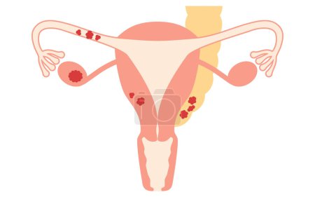 Ilustración de Ilustración diagramática del cáncer de ovario en estadio II, anatomía del útero y los ovarios, anatomía del útero y los ovarios - Traducción: El cáncer está presente en uno o ambos ovarios o trompas de Falopio y se diseminó hasta el útero y las trompas de Falopio en - Imagen libre de derechos
