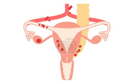 Illustration schématique du cancer de l'ovaire de stade III, anatomie de l'utérus et des ovaires, anatomie de l'utérus et des ovaires - Traduction : Le cancer s'est propagé aux ganglions lymphatiques ou à travers la cavité pelvienne au péritoine, au grand mésentère ou aux petits i