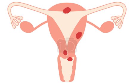 Ilustración de Ilustración diagramática del cáncer de cuello uterino, anatomía del útero y ovarios, ilustración vectorial - Imagen libre de derechos