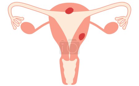 Illustrations illustratives du cancer de l'endomètre, anatomie de l'utérus et des ovaires, Illustration vectorielle