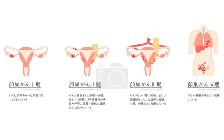 Ilustración diagramática del cáncer de ovario en estadio I, anatomía del útero y los ovarios, anatomía del útero y los ovarios - Traducción: El cáncer se limita a los ovarios o las trompas de Falopio