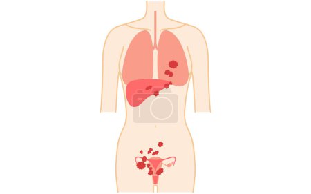 Ilustración diagramática del cáncer de ovario en estadio IV, anatomía del útero y los ovarios, anatomía del útero y los ovarios - Traducción: El cáncer se diseminó al hígado, los pulmones, etc..