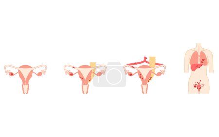 Diagrammatische Darstellung von Eierstockkrebs im Stadium I, Anatomie der Gebärmutter und der Eierstöcke, Anatomie der Gebärmutter und der Eierstöcke - Übersetzung: Krebs beschränkt sich auf die Eierstöcke oder Eileiter