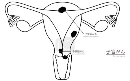 Diagrammatische Darstellung von Gebärmutterhalskrebs, Anatomie der Gebärmutter und der Eierstöcke, Vektorillustration