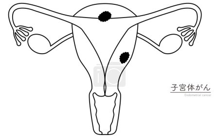 Illustrative Illustrationen zu Endometriumkrebs, Anatomie der Gebärmutter und der Eierstöcke, Vektorillustration