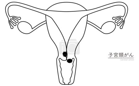 Diagrammatic illustration of cervical cancer, anatomy of the uterus and ovaries, Vector Illustration
