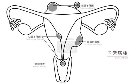 Diagrammatic illustration of uterine fibroids, anatomy of the uterus and ovaries, Vector Illustration