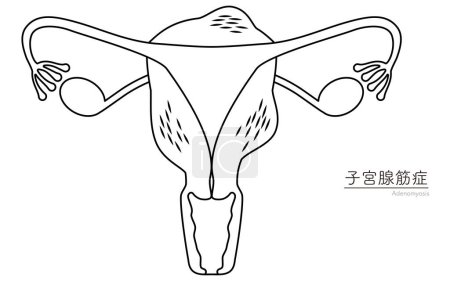 Diagrammatische Darstellung der Adenomyose, Anatomie der Gebärmutter und der Eierstöcke, Vektorillustration