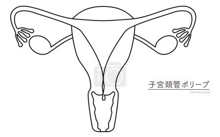 Illustration schématique des polypes cervicaux, anatomie de l'utérus et des ovaires, Illustration vectorielle