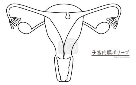Diagrammatische Darstellung der endometrischen Polypen, Anatomie der Gebärmutter und der Eierstöcke, Vektorillustration