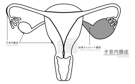 Diagrammatische Darstellung der Endometriose, Anatomie der Gebärmutter und der Eierstöcke, Vektorillustration