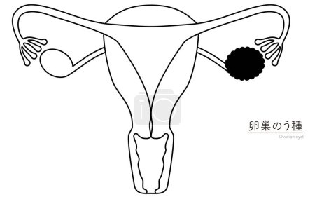 Diagrammatische Darstellung der Zysten der Eierstöcke, Anatomie der Gebärmutter und der Eierstöcke, Vektorillustration
