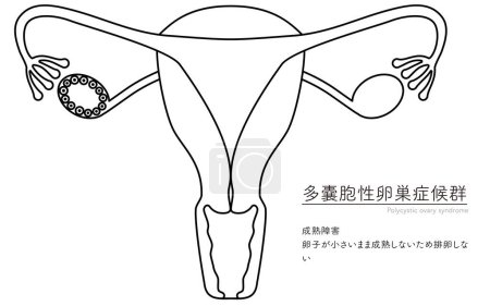 Ilustración diagramática del síndrome del ovario poliquístico (trastorno de maduración), anatomía del útero y los ovarios - Traducción: Fracaso de maduración Falta de ovulación porque el ovocito sigue siendo pequeño y no madura