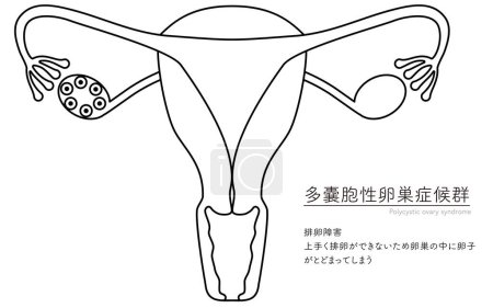 Diagrammatische Darstellung des polyzystischen Ovar-Syndroms (Ovulationsstörung), der Anatomie der Gebärmutter und der Eierstöcke - Übersetzung: Ovulationsversagen Gelingt der Eisprung nicht, bleibt die Eizelle im Ovar.