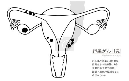 Ilustración diagramática del cáncer de ovario en estadio II, anatomía del útero y los ovarios, anatomía del útero y los ovarios - Traducción: El cáncer está presente en uno o ambos ovarios o trompas de Falopio y se diseminó hasta el útero y las trompas de Falopio en 
