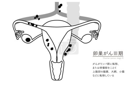 Illustration schématique du cancer de l'ovaire de stade III, anatomie de l'utérus et des ovaires, anatomie de l'utérus et des ovaires - Traduction : Le cancer s'est propagé aux ganglions lymphatiques ou à travers la cavité pelvienne au péritoine, au grand mésentère ou aux petits i