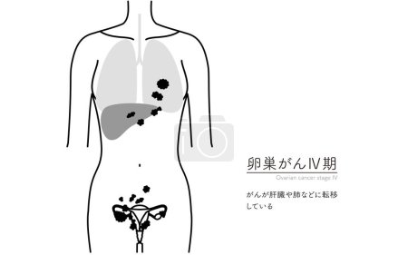 Ilustración de Ilustración diagramática del cáncer de ovario en estadio IV, anatomía del útero y los ovarios, anatomía del útero y los ovarios - Traducción: El cáncer se diseminó al hígado, los pulmones, etc.. - Imagen libre de derechos