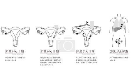 Illustration schématique du cancer de l'ovaire de stade I, anatomie de l'utérus et des ovaires, anatomie de l'utérus et des ovaires - Traduction : Le cancer est confiné aux ovaires ou trompes de Fallope